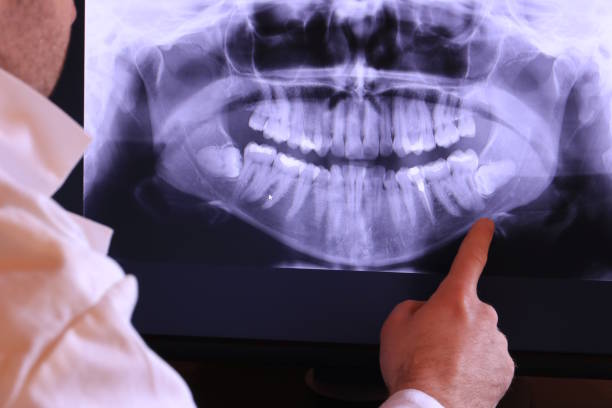 Best Emergency Wisdom Teeth Removal in Contoocook, NH